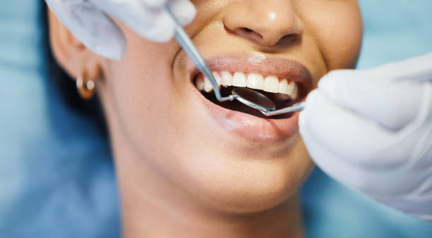 Best Knocked-Out Tooth (Avulsed Tooth) Treatment in Kincaid, IL